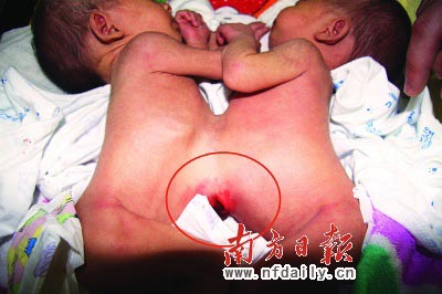 連體女嬰成功實(shí)施分離手術(shù)后出院(組圖)