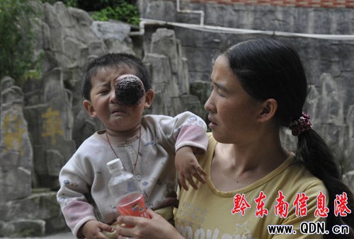 一歲兒子左眼掛巨大腫瘤 多方求醫未果急壞父母