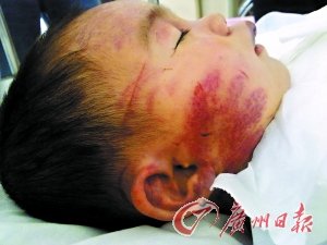 后媽虐打3歲女童 將其打致腦出血扔在便池內(nèi)