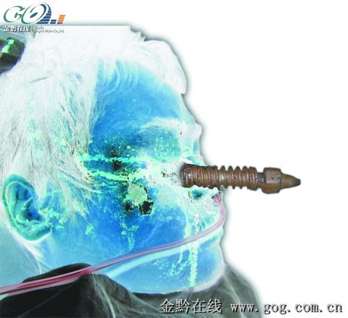 右眼拔出18公分螺栓 修打米機(jī)出意外所致(圖)