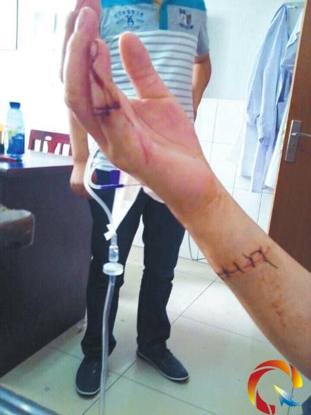 高三女生拒陪室友聊天被劃5刀 其中1刀在臉上